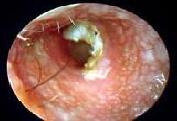 Dr. Szalmay - fül-orr-gégész szakorvos - Otitis externa